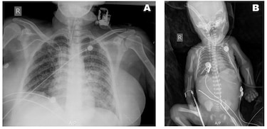 Tuberculosis en Panamá: mueren madre y bebé; estudio expone fallas en el diagnóstico