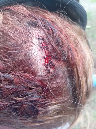 Funcionaria del Inadeh fue atacada con piedras y machete en Changuinola, Bocas del Toro