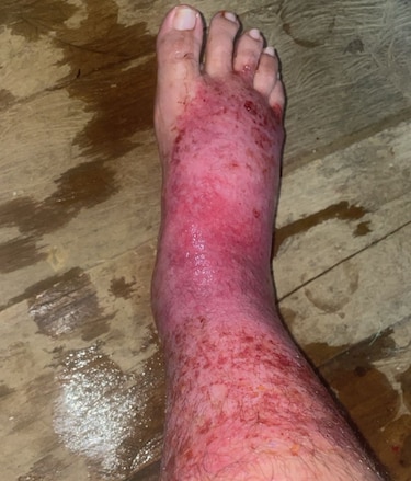 Maestro de la comarca Ngäbe Buglé necesita traslado urgente a una instalación de salud