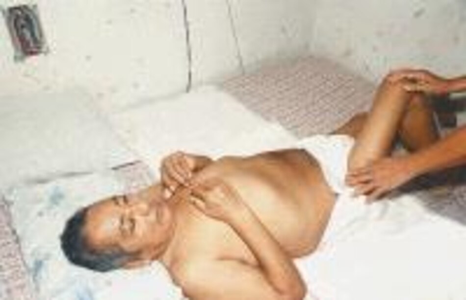 La sobrerradiación me obliga a usar pañales