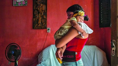 Microcefalia por zika