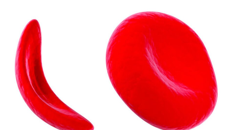 10 mitos de la anemia falciforme