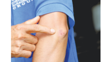 Aumentan los casos de leishmaniasis durante 2021