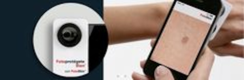 La marca inofensiva o cancerígena de un lunar