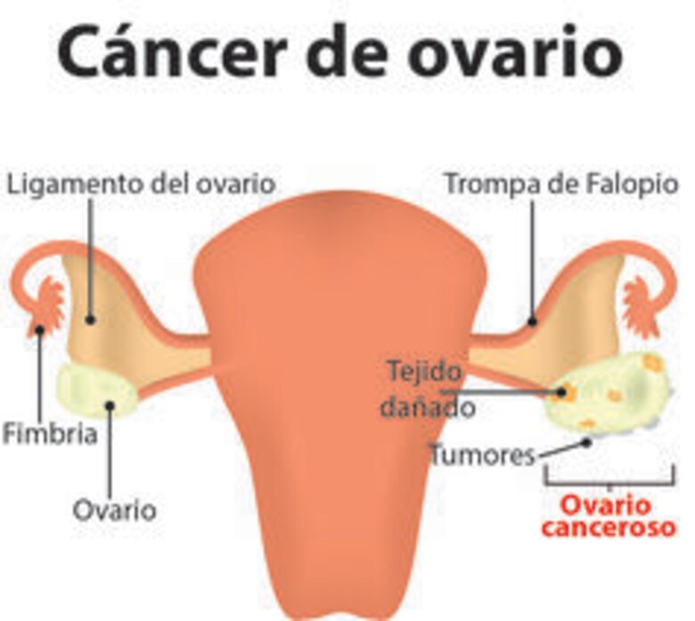 Tras la amenaza del silencioso cáncer de ovario