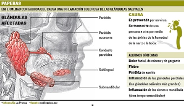 Ministerio de Salud descarta brote de paperas en el país