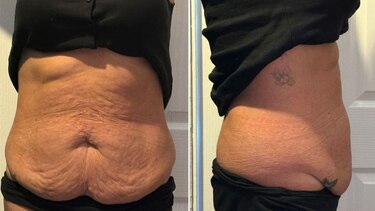 Perdieron kilos con las inyecciones para bajar de peso, pero luego vino la piel flácida