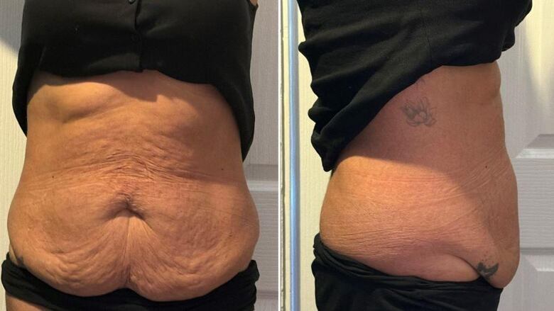 Perdieron kilos con las inyecciones para bajar de peso, pero luego vino la piel flácida