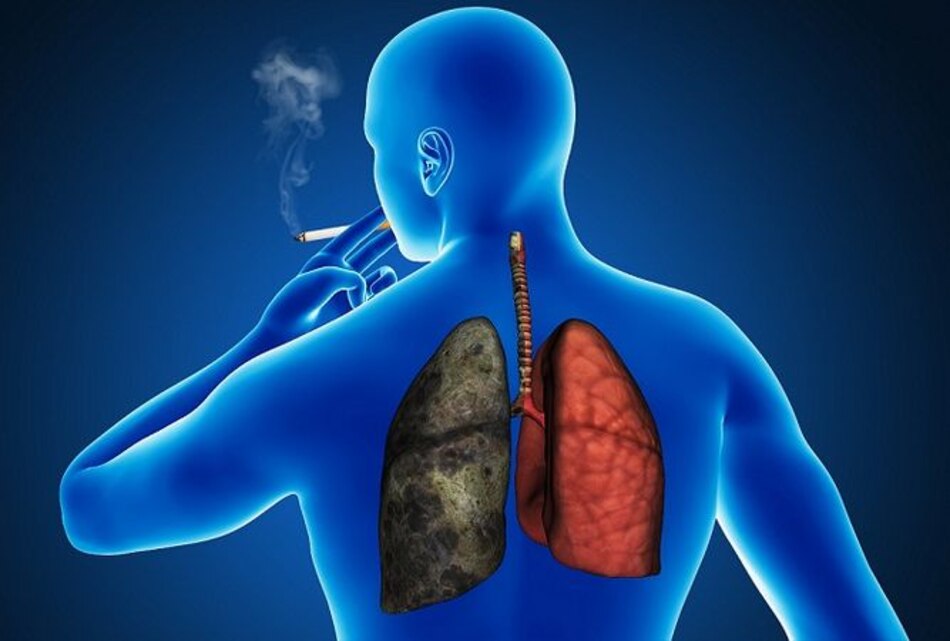 Latinoamérica desconoce sobre el cáncer pulmonar