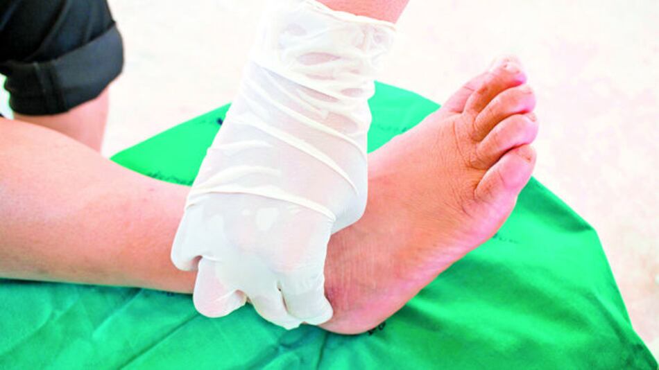 Neuroartropatía de Charcot