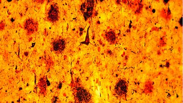 Resultados prometedores contra el Alzheimer