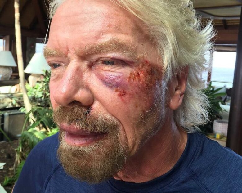 Multimillonario Richard Branson sufre accidente: 'pensé que moriría; usar casco me salvó la vida'