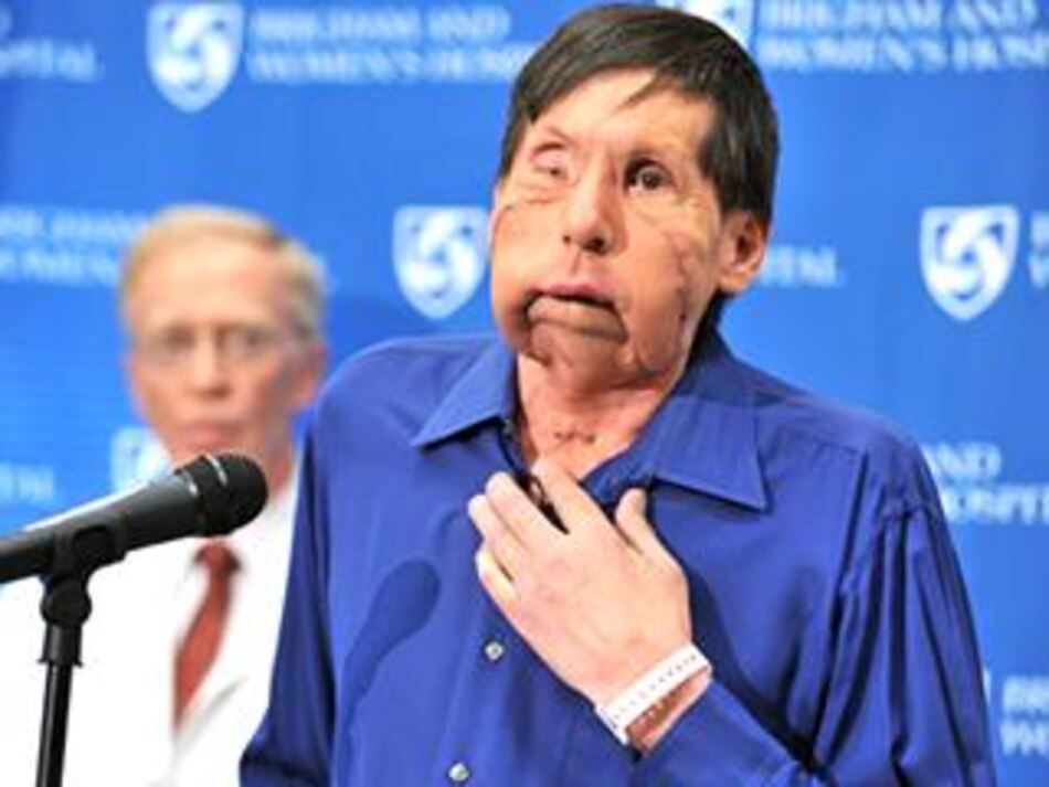 Hombre que recibió trasplante de cara se presenta en público