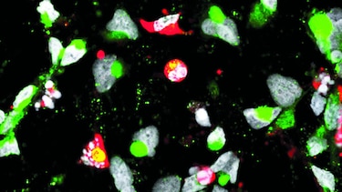 Zika, clave para tratar el cáncer