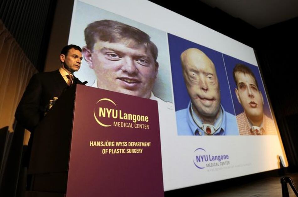 Realizan el trasplante de cara más complejo hasta la fecha