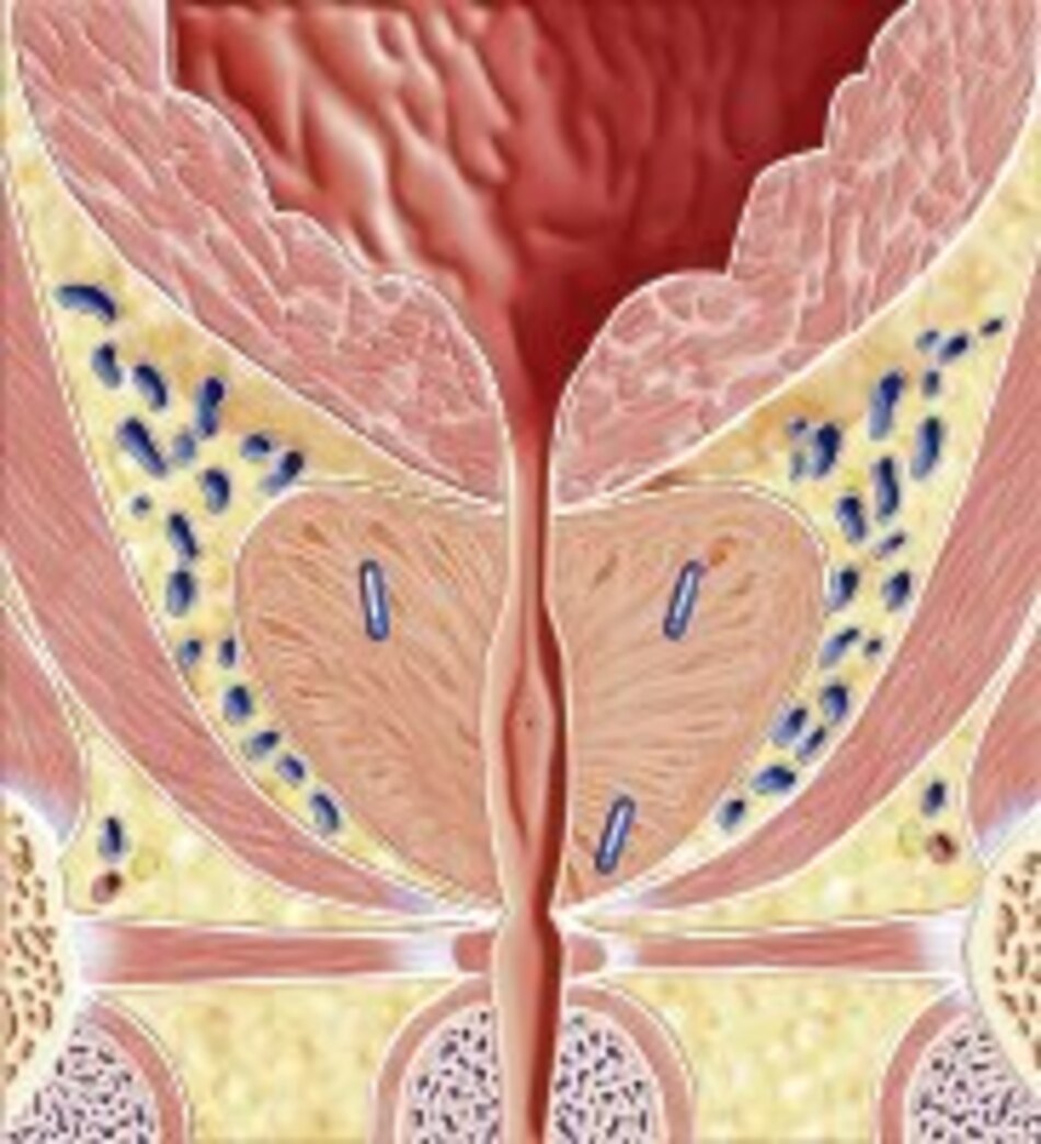 Rayos y semillas contra el cáncer