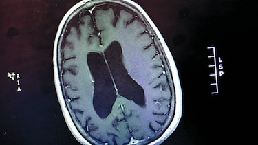 El alzheimer en el contexto de la salud mental