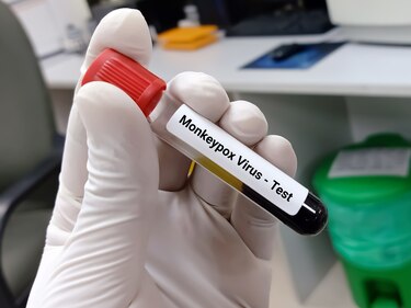 Viruela del mono podría afectar con mayor gravedad a personas con VIH avanzado: ‘The Lancet’