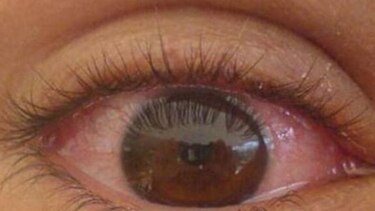 Se reportan 2 mil 719 casos de conjuntivitis