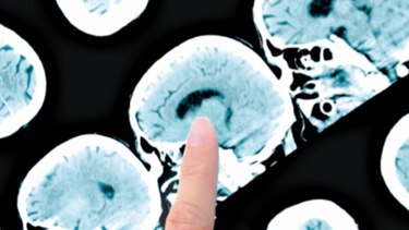 IA podría ser clave para cirugía de tumores cerebrales