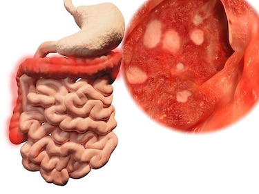 Inflamación intestinal