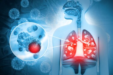 Una alianza para luchar contra el cáncer de pulmón