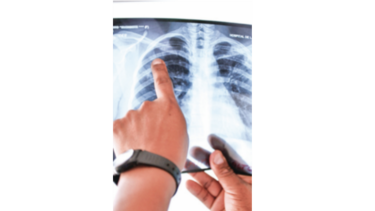 Se establecen normas clínicas para manejo de pacientes con tuberculosis drogoresistente