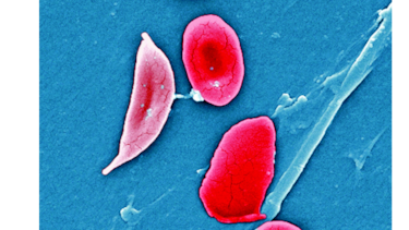 Avances en la anemia