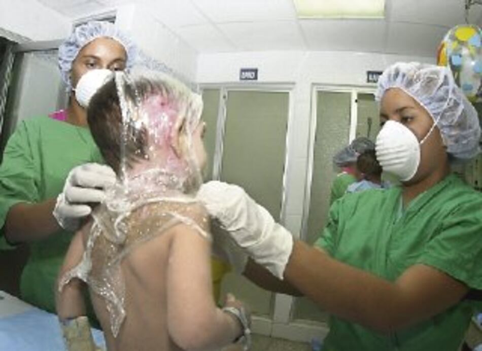 30 casos de niños quemados en 19 días