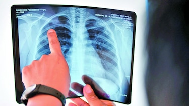 Se incrementan los casos de tuberculosis, advierte el Minsa