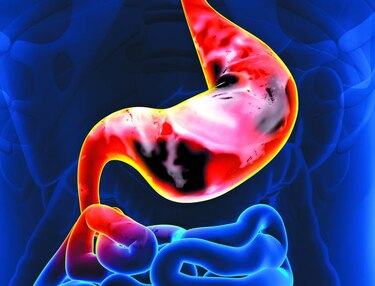 Una mirada al cáncer gástrico